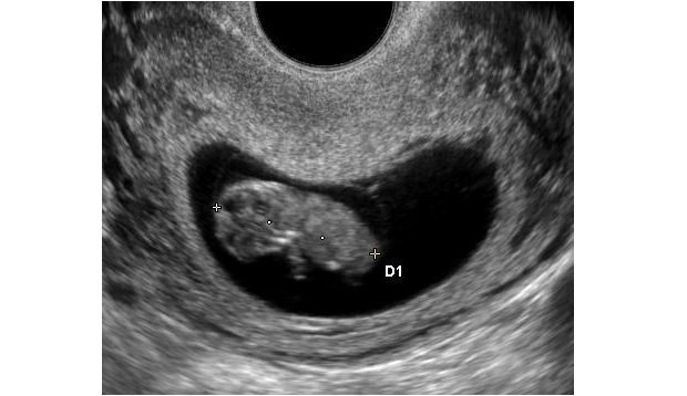 Zdjęcie z badania usg, płód